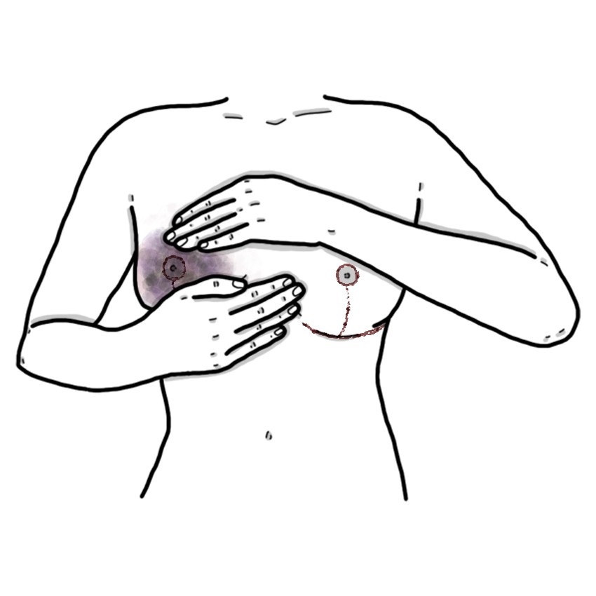 Haematoma after breast surgery