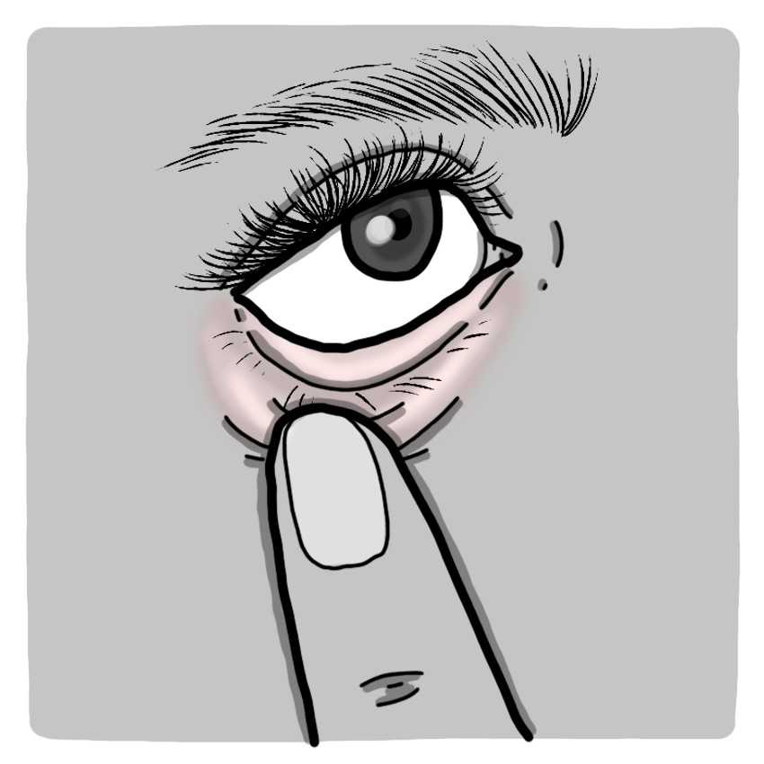 Anaemia - Anaemic syndrome