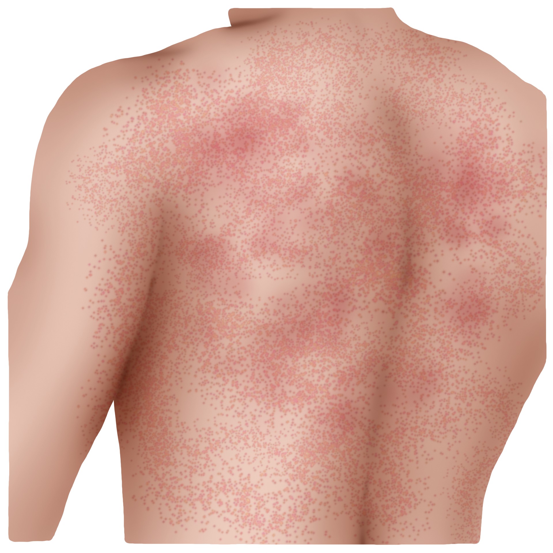 Measles (Paediatrics)