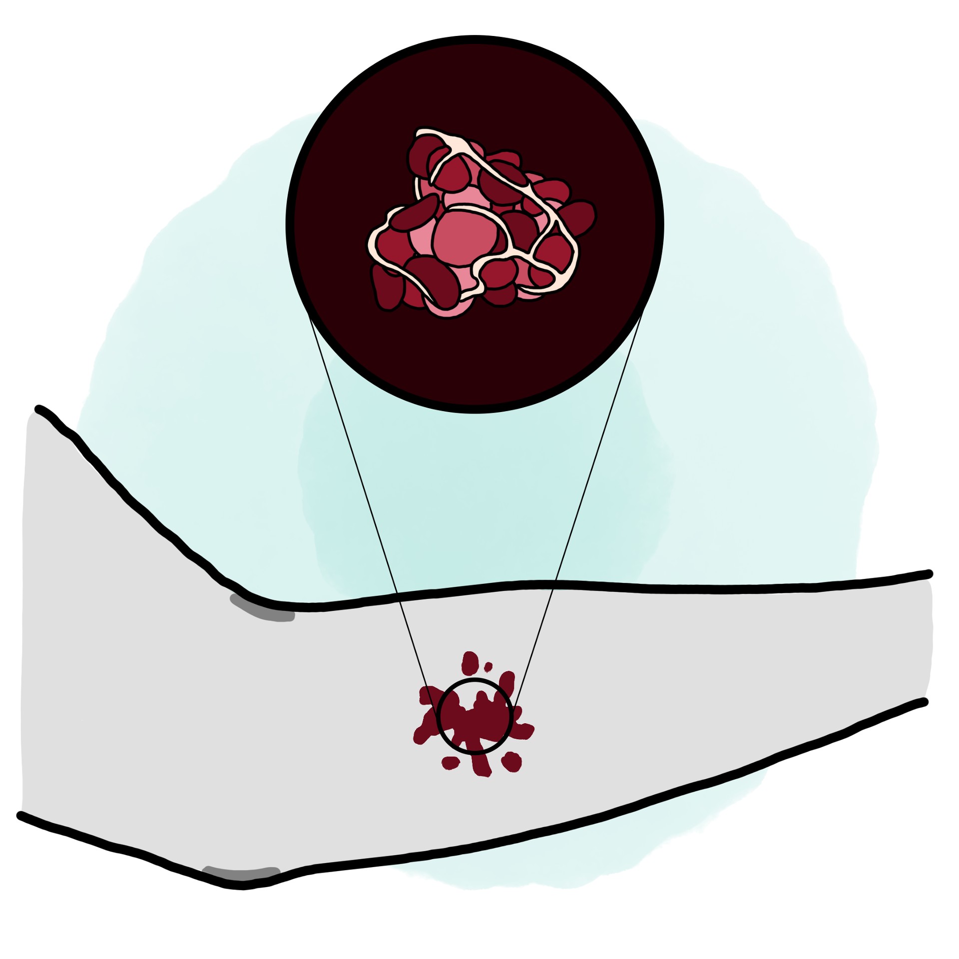 Disseminated Intravascular Coagulation - DIC