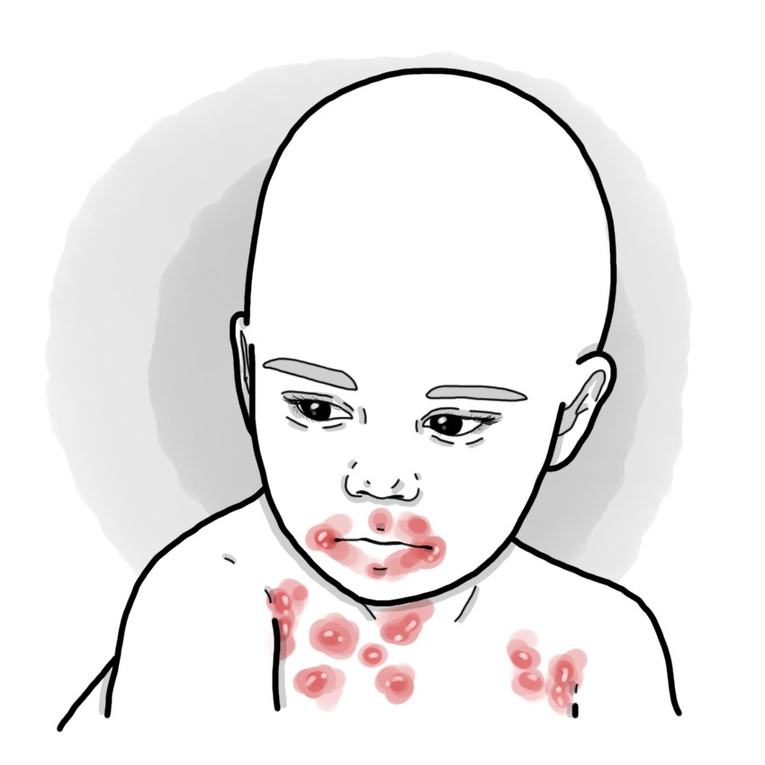 Scalded skin syndrome - Ritter's disease (Paediatrics)