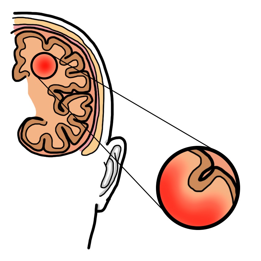 Hemorragia cerebral intraparenquimatosa