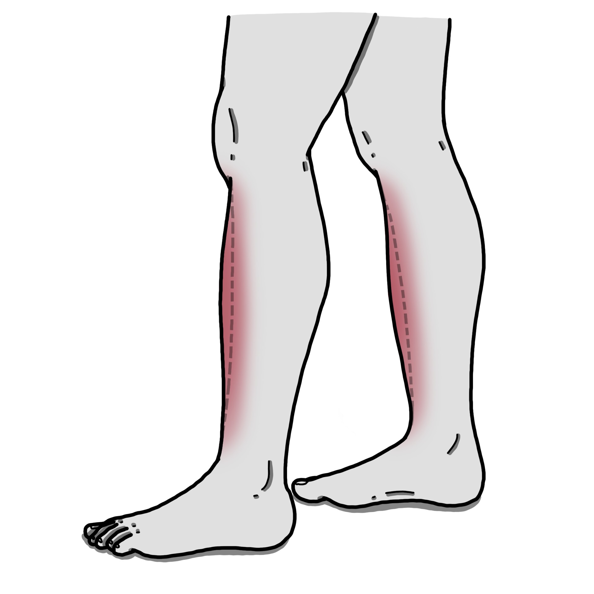 Pretibial myxoedema