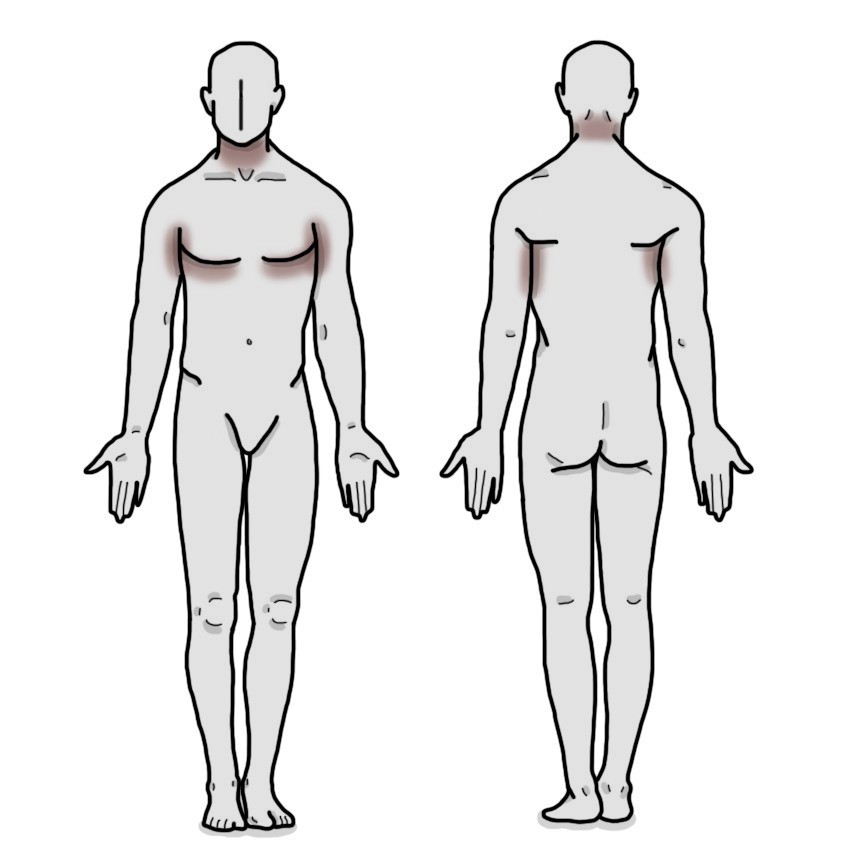 Acanthosis nigricans