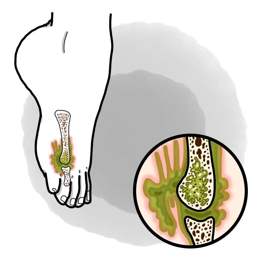 Osteomyelitis (Paediatrics)