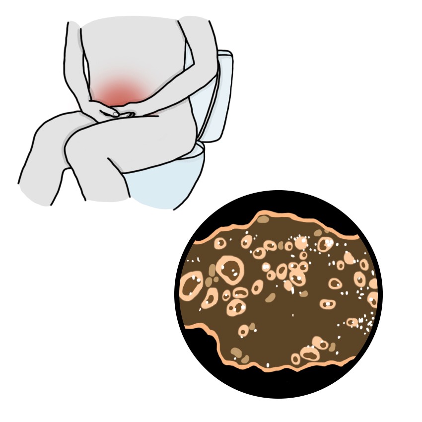 Diarrhée riche en graisse