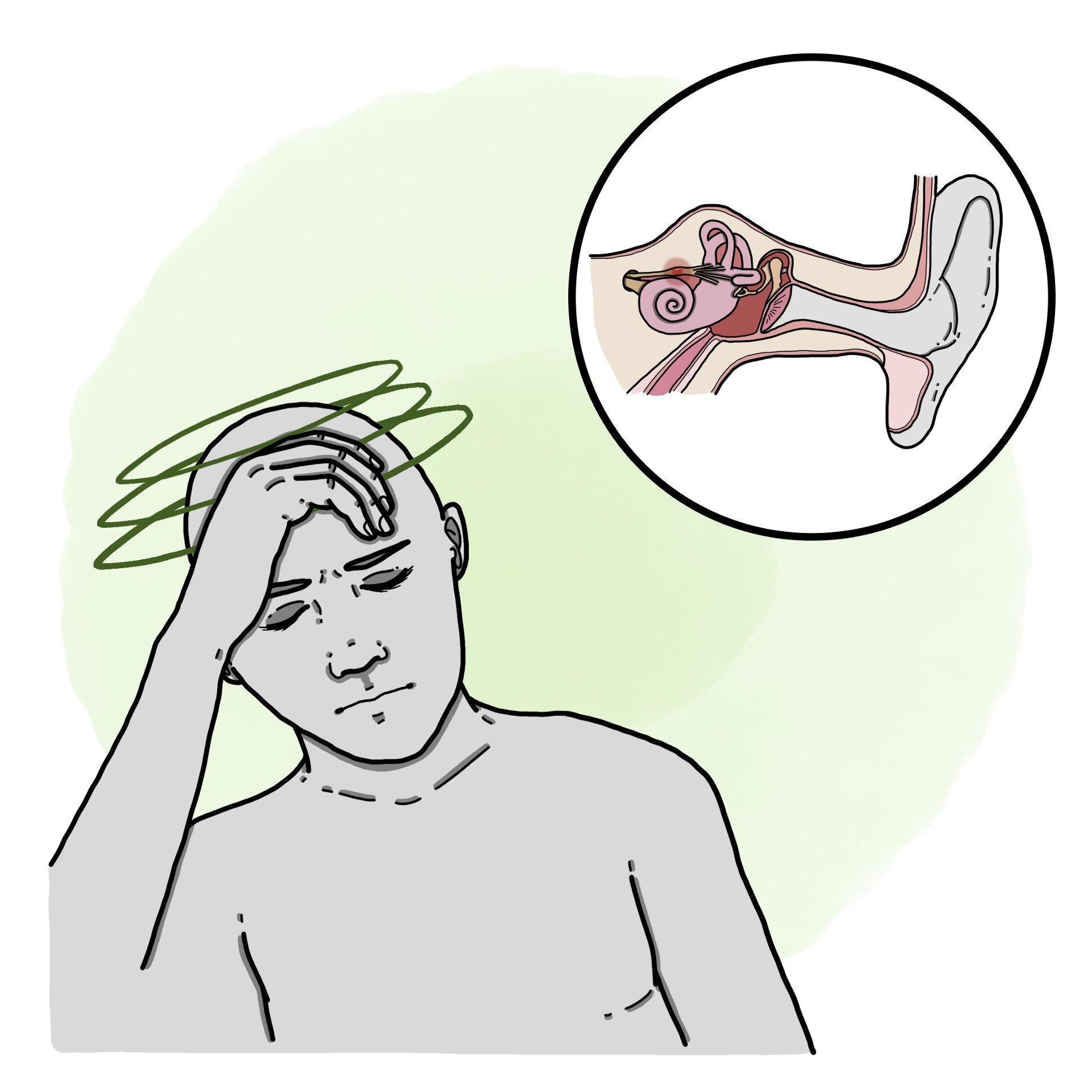 Peripheral vertigo due to vestibular neuritis