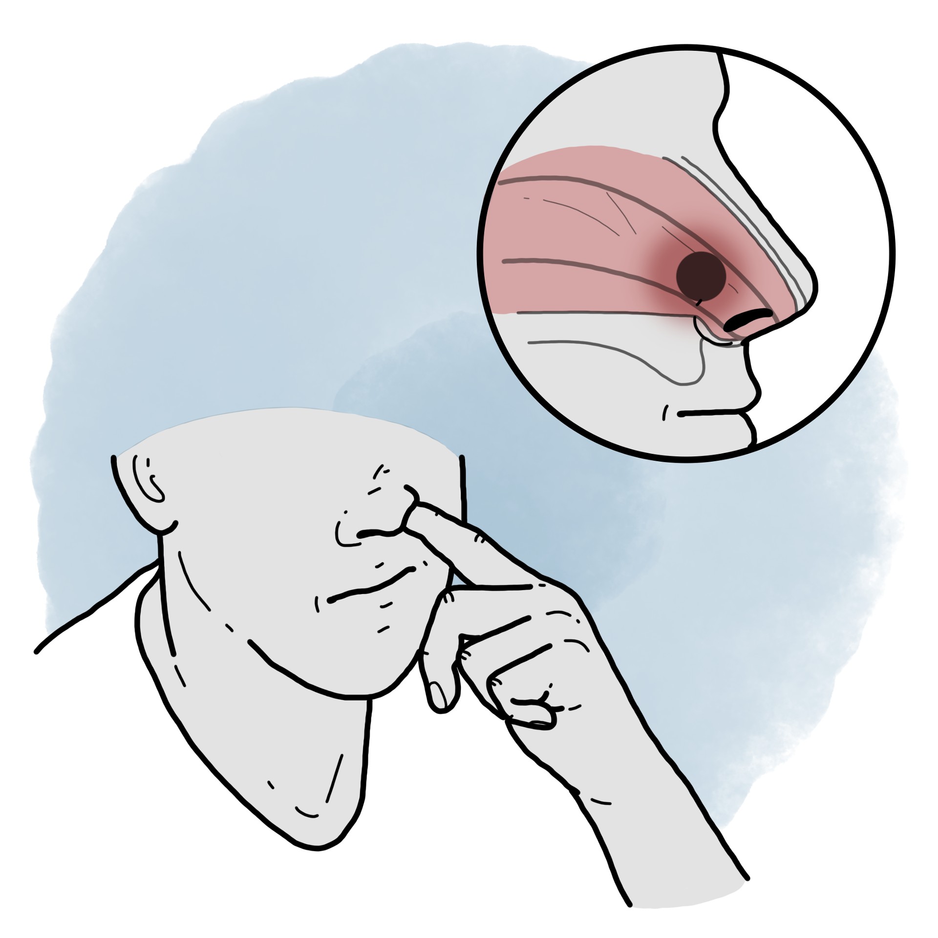 Object inside the nose - Intranasal foreign body