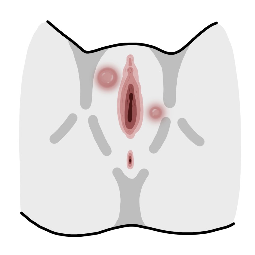 Lump in the genital area