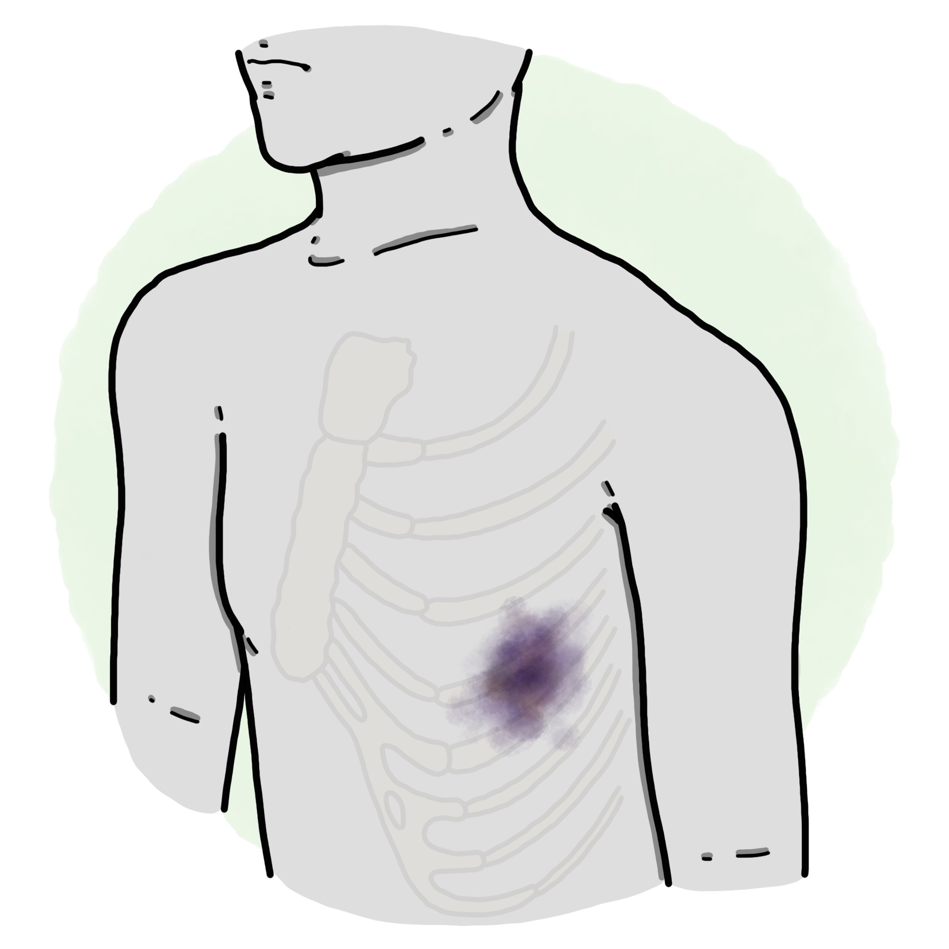 Rib trauma - Costal contusion