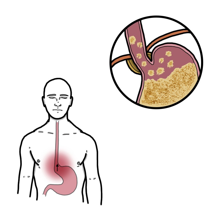 Gastro-oesophageal reflux