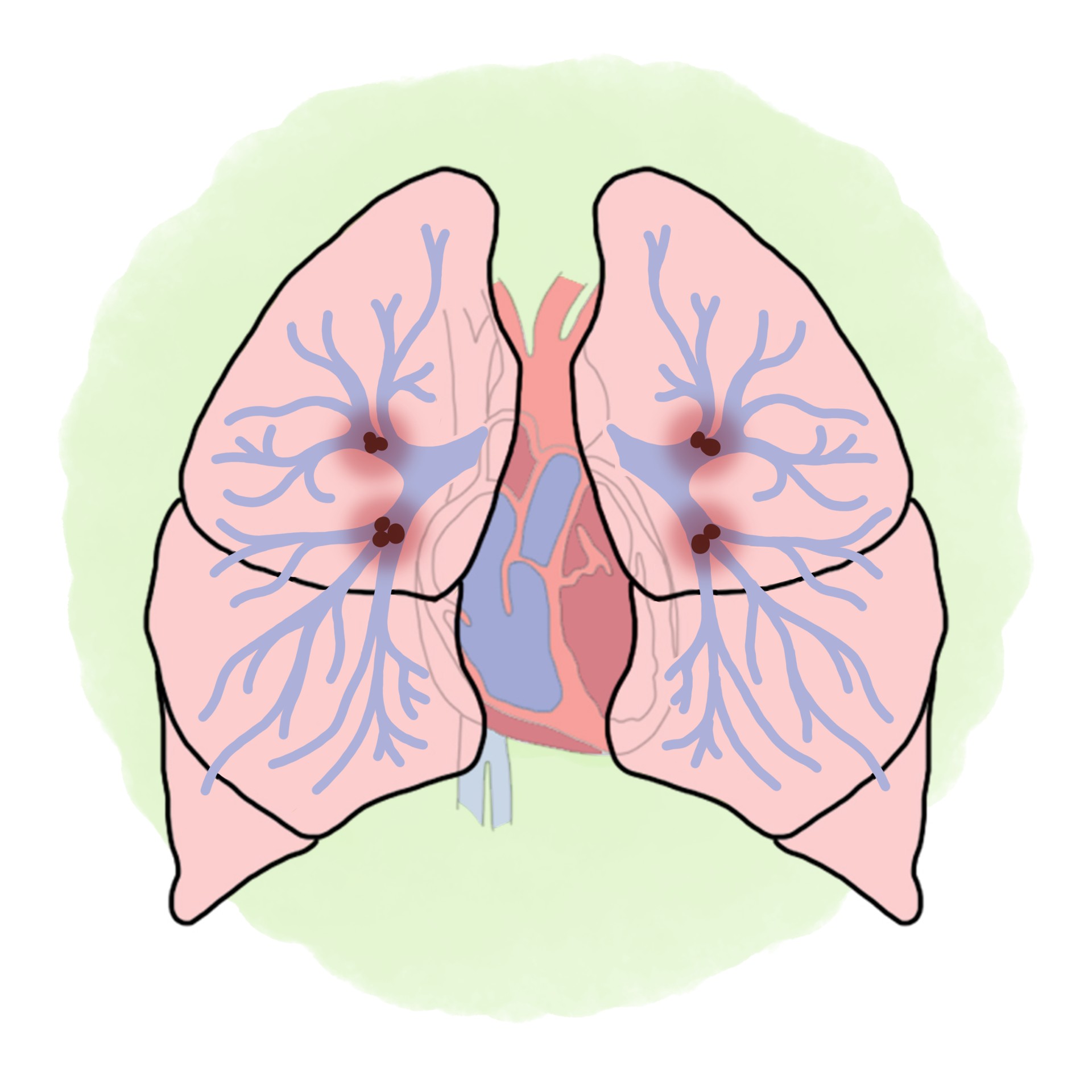 Pulmonary embolism