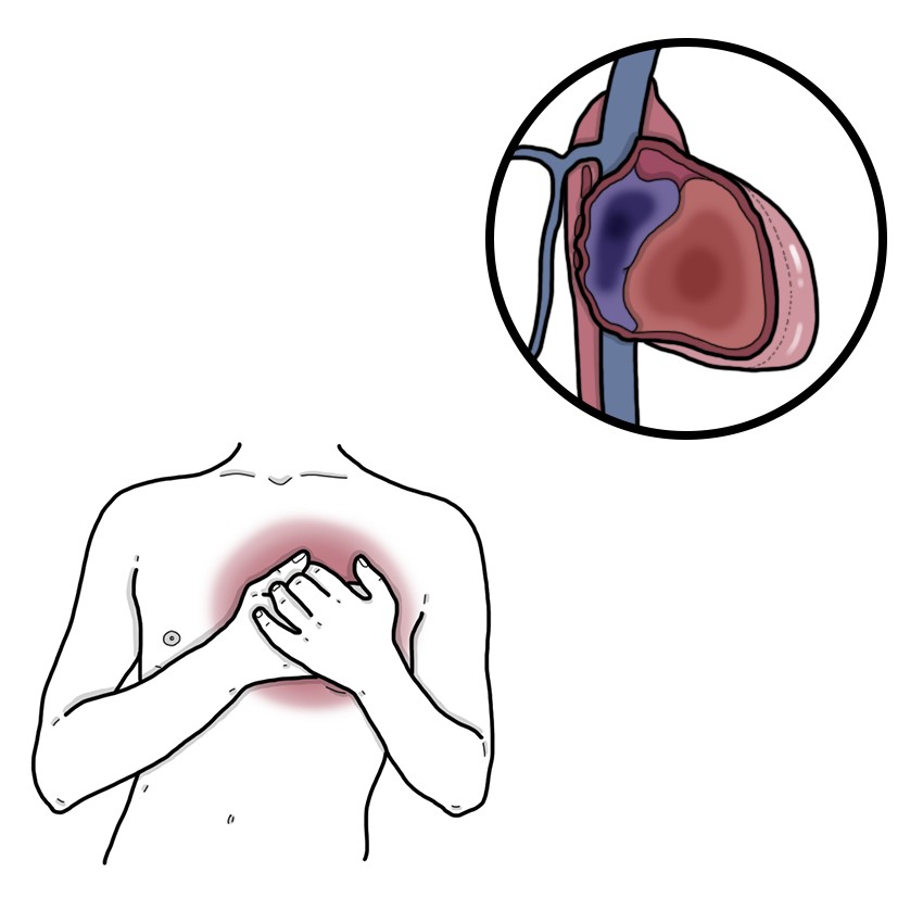 Pericarditis