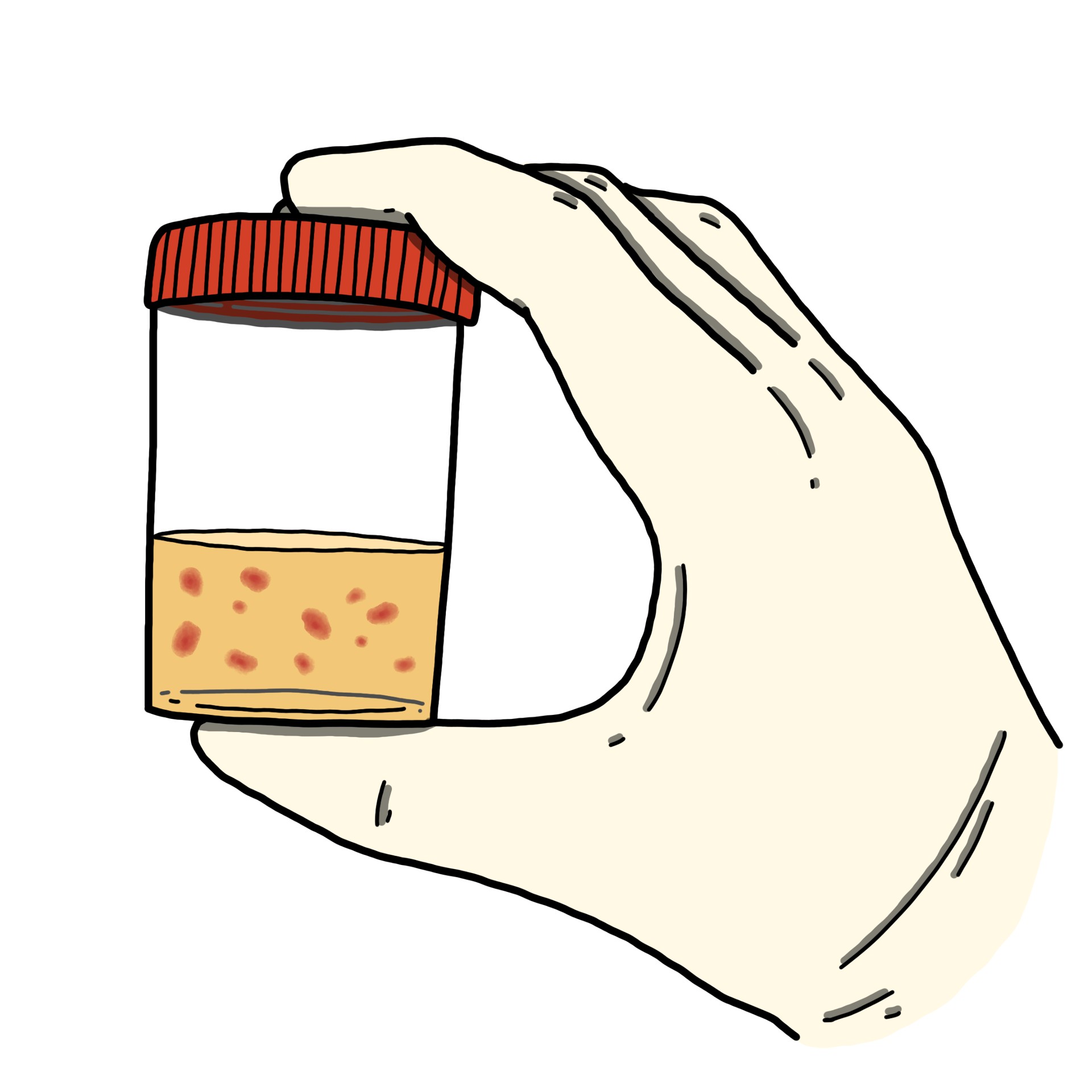 Urina com coágulos de sangue