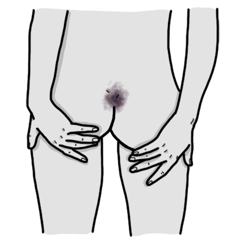 Trauma to the coccyx