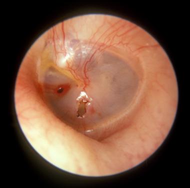 Eardrum rupture or perforation