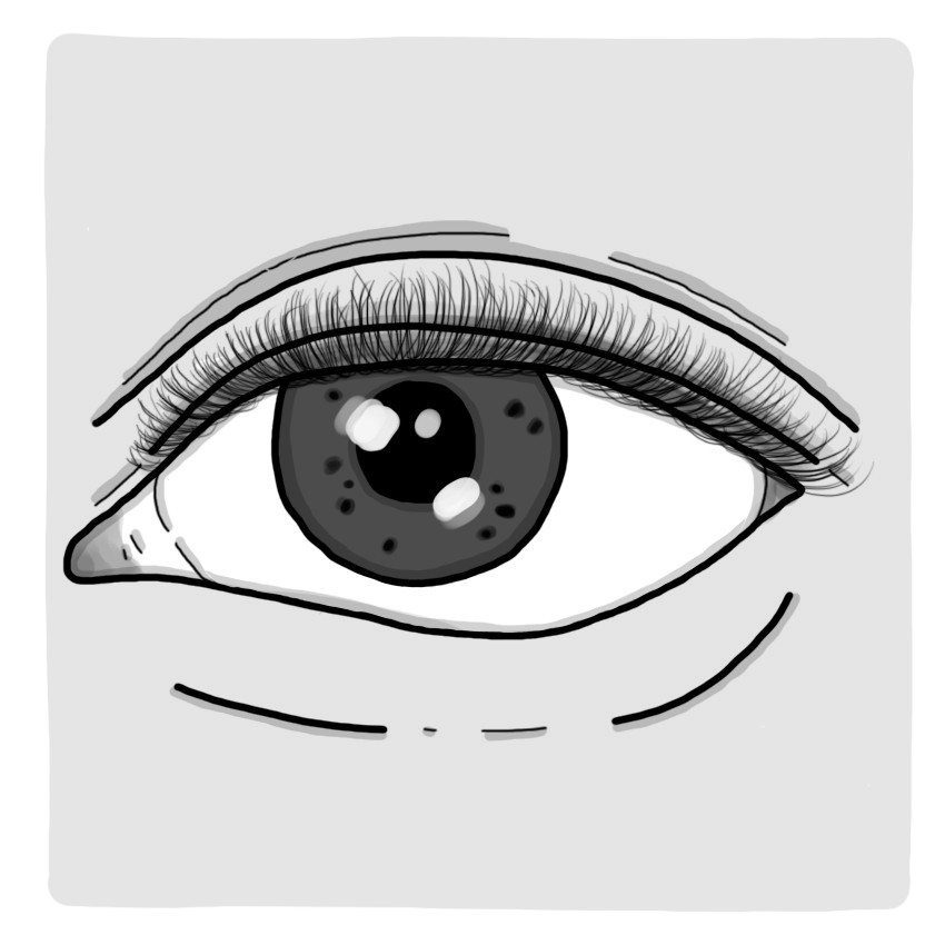 虹彩に濃いシミ