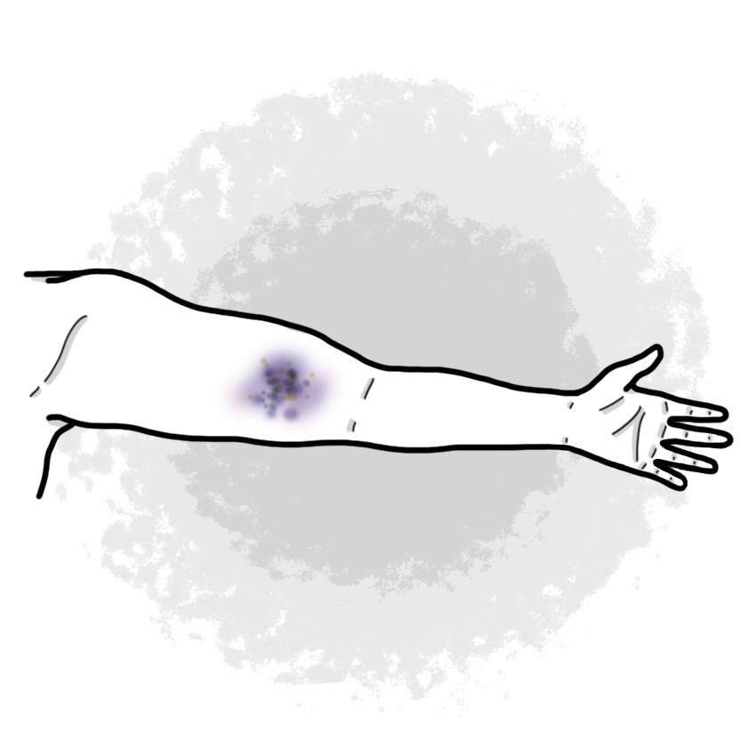 Arm trauma - Upper limb contusion