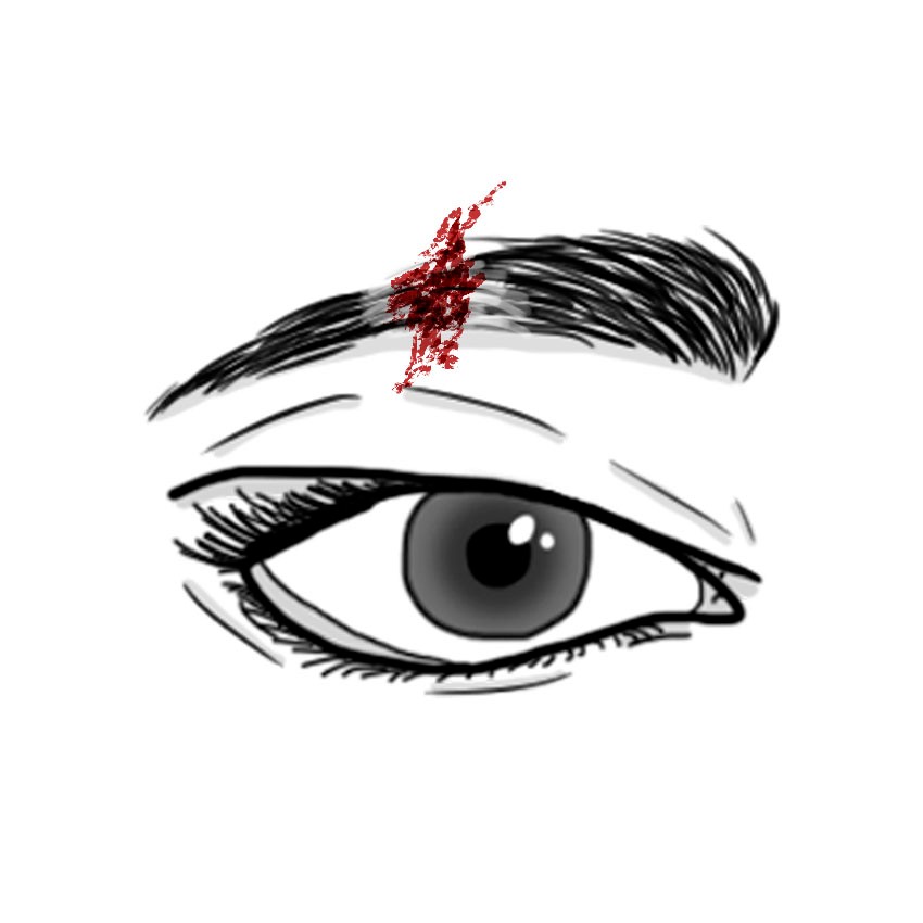 Eyebrow wound