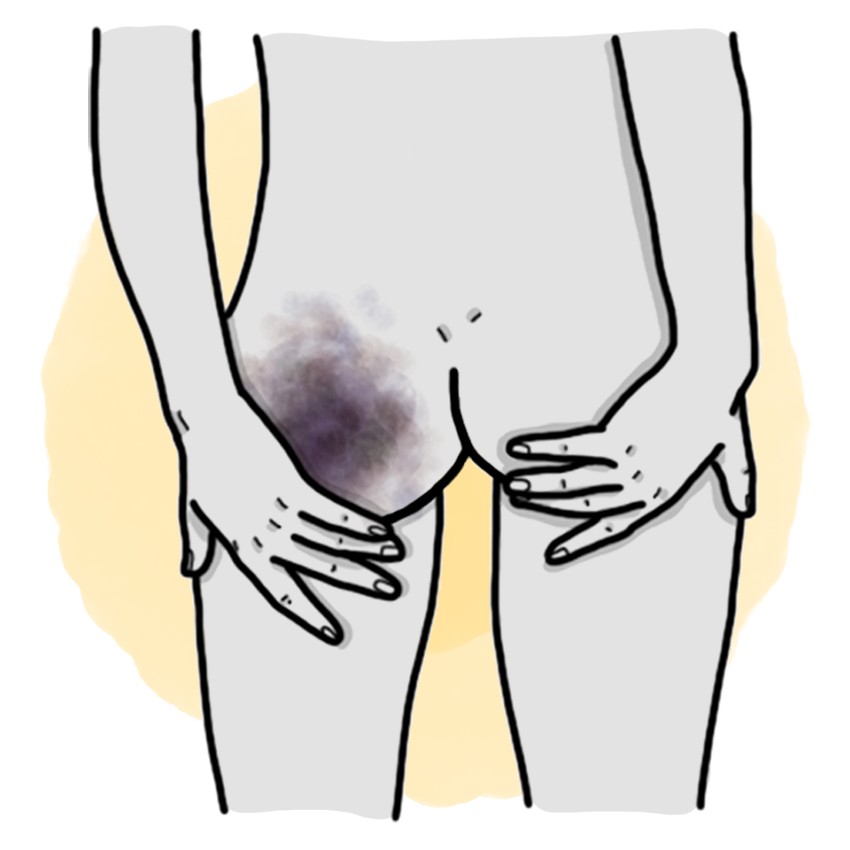Buttock trauma - Gluteal contusion