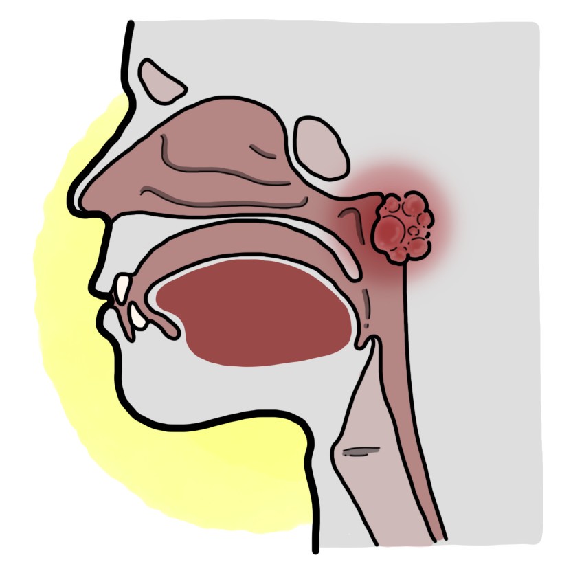 Nasopharyngeal cancer - Nasopharyngeal carcinoma