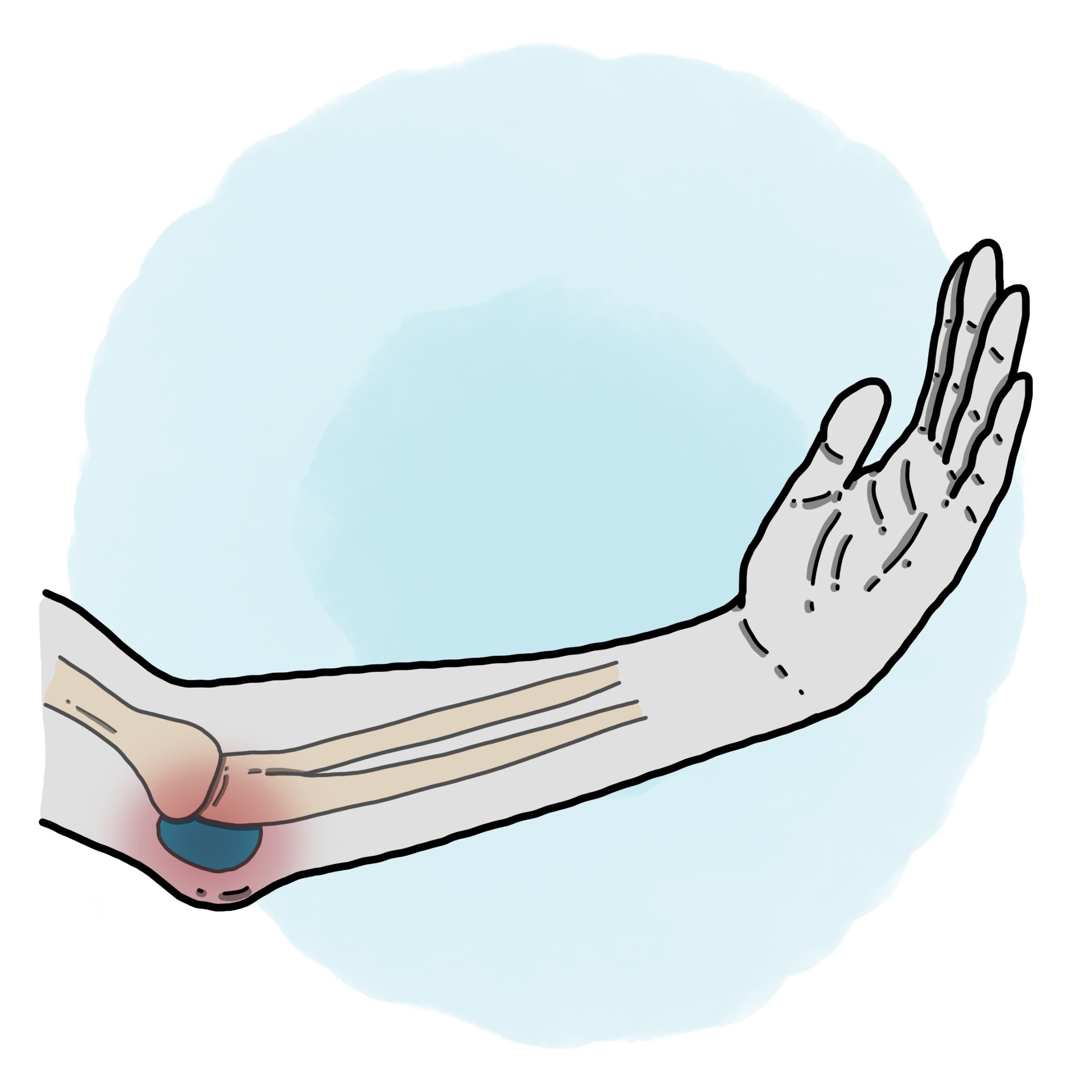 Elbow bursitis