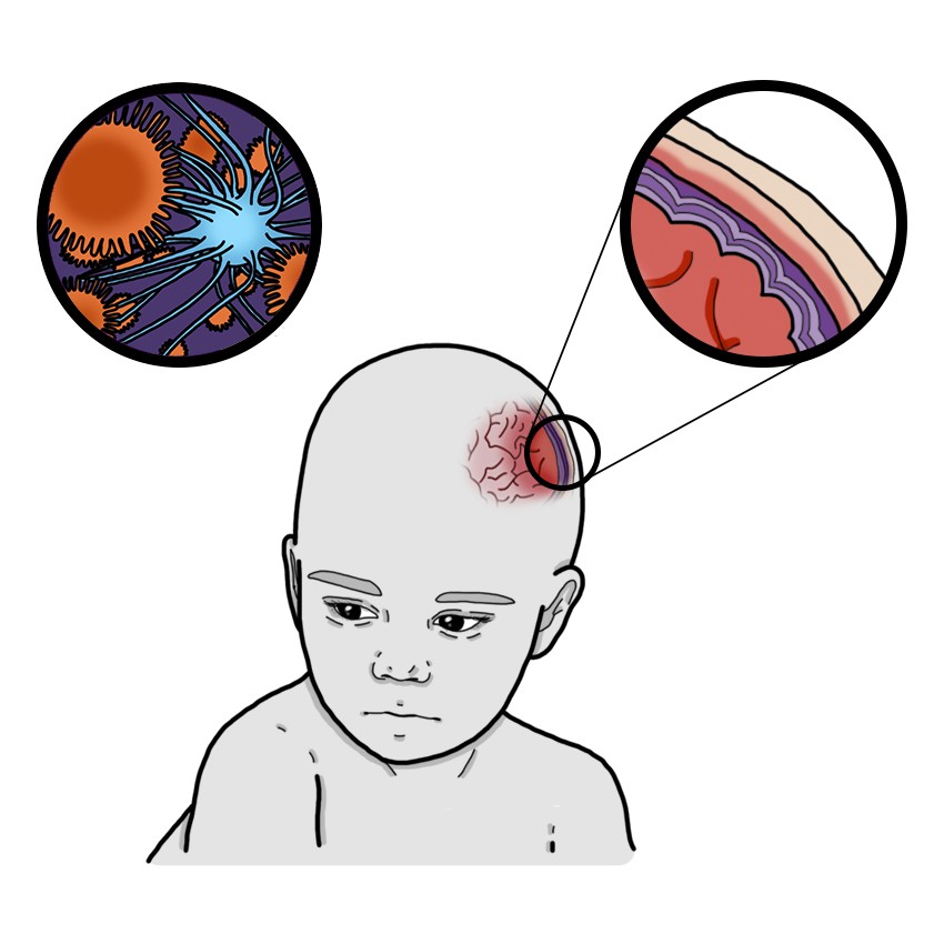 Viral meningitis (Paediatrics)