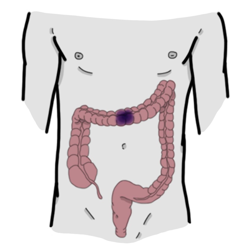 Mesenteric ischaemia