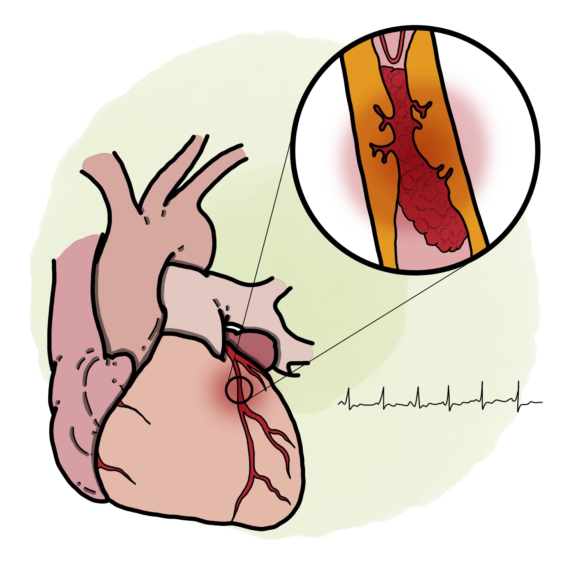 Acute heart attack - Non-ST elevated myocardial infarct - NSTEMI
