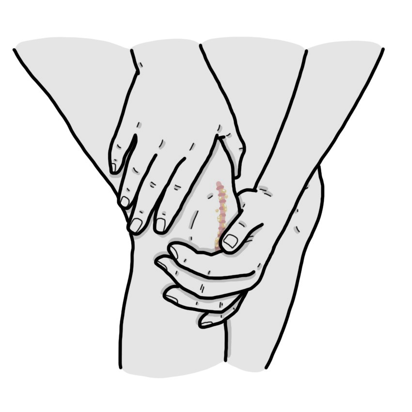 Pus in the surgical wound