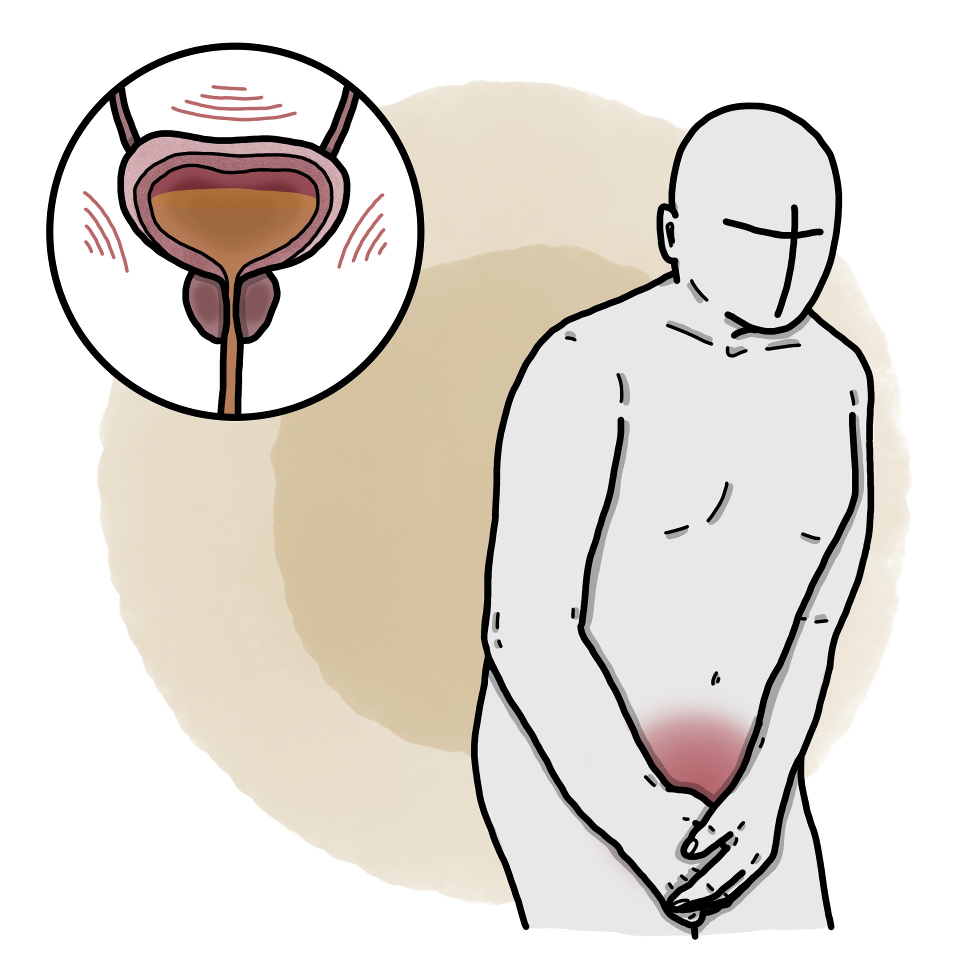 Acute urinary retention - AUR