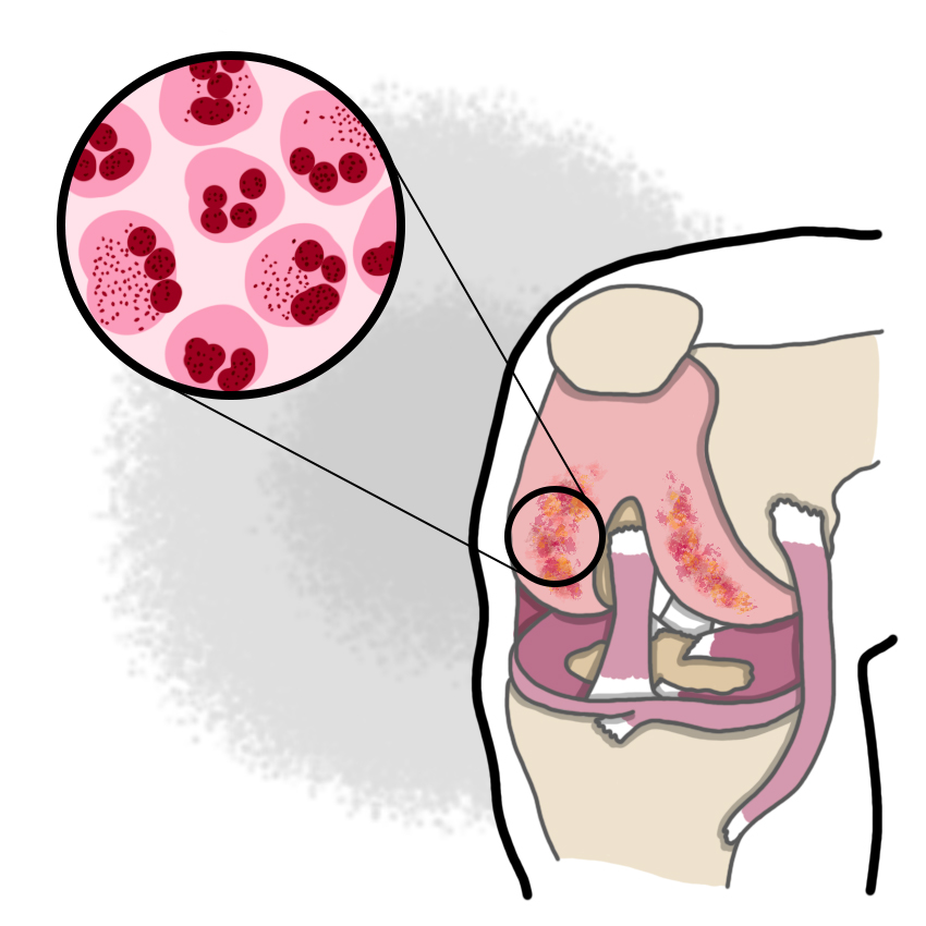 Systemic gonococcal infection