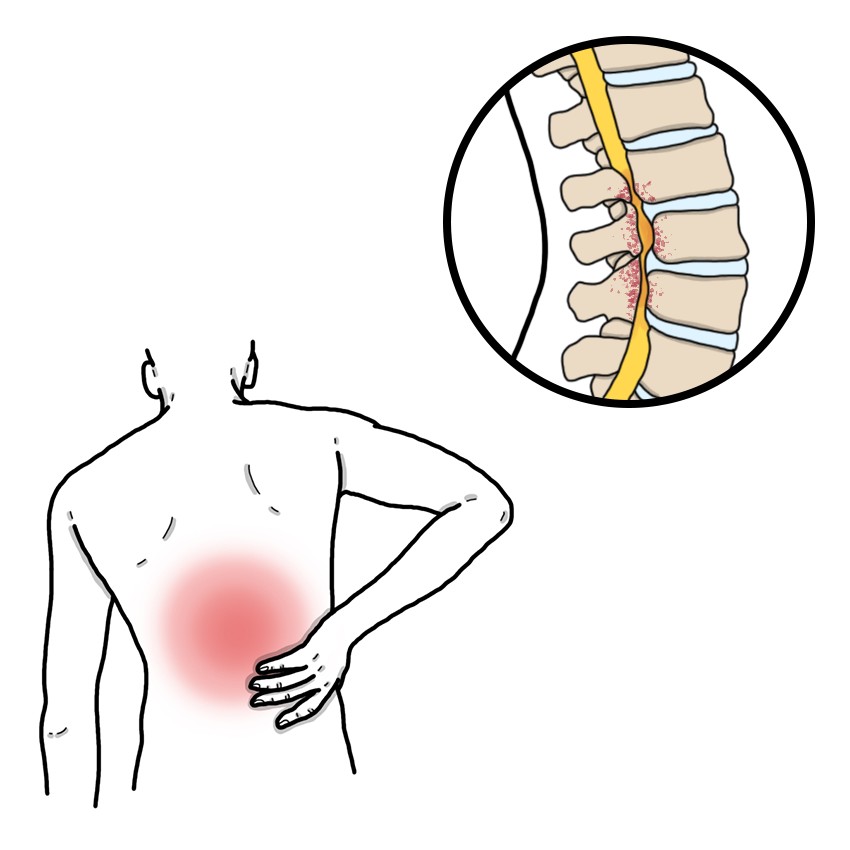 Spinal canal stenosis