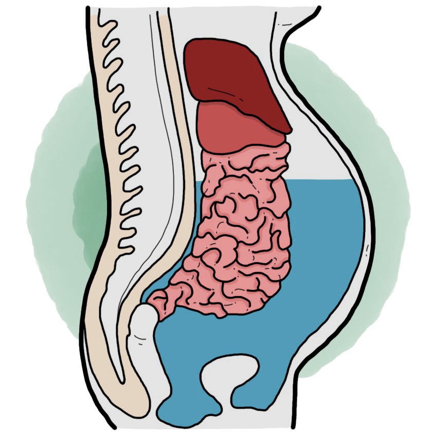 Ascites - Hyperperitoneum