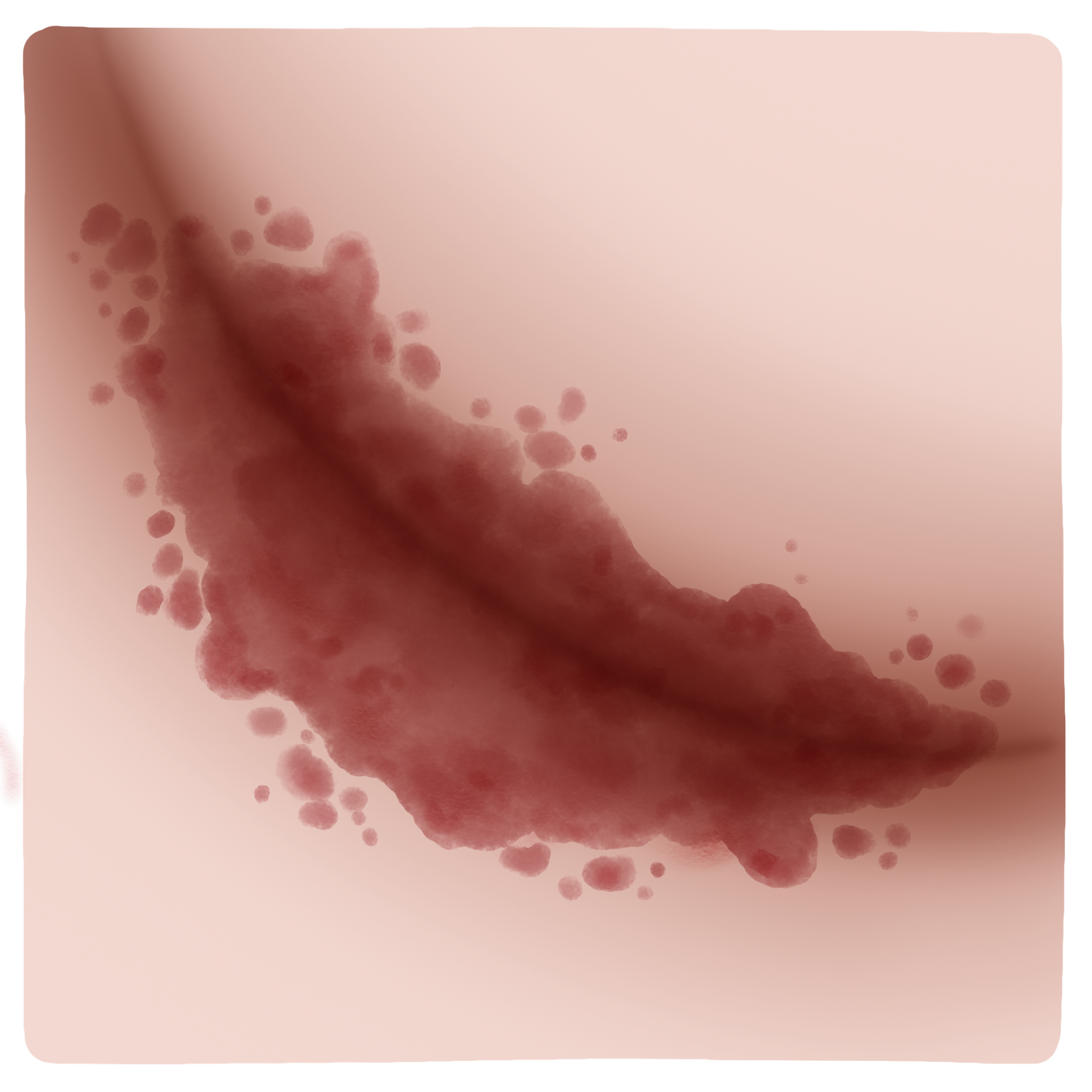 Maceration of the folds of the skin - Intertrigo