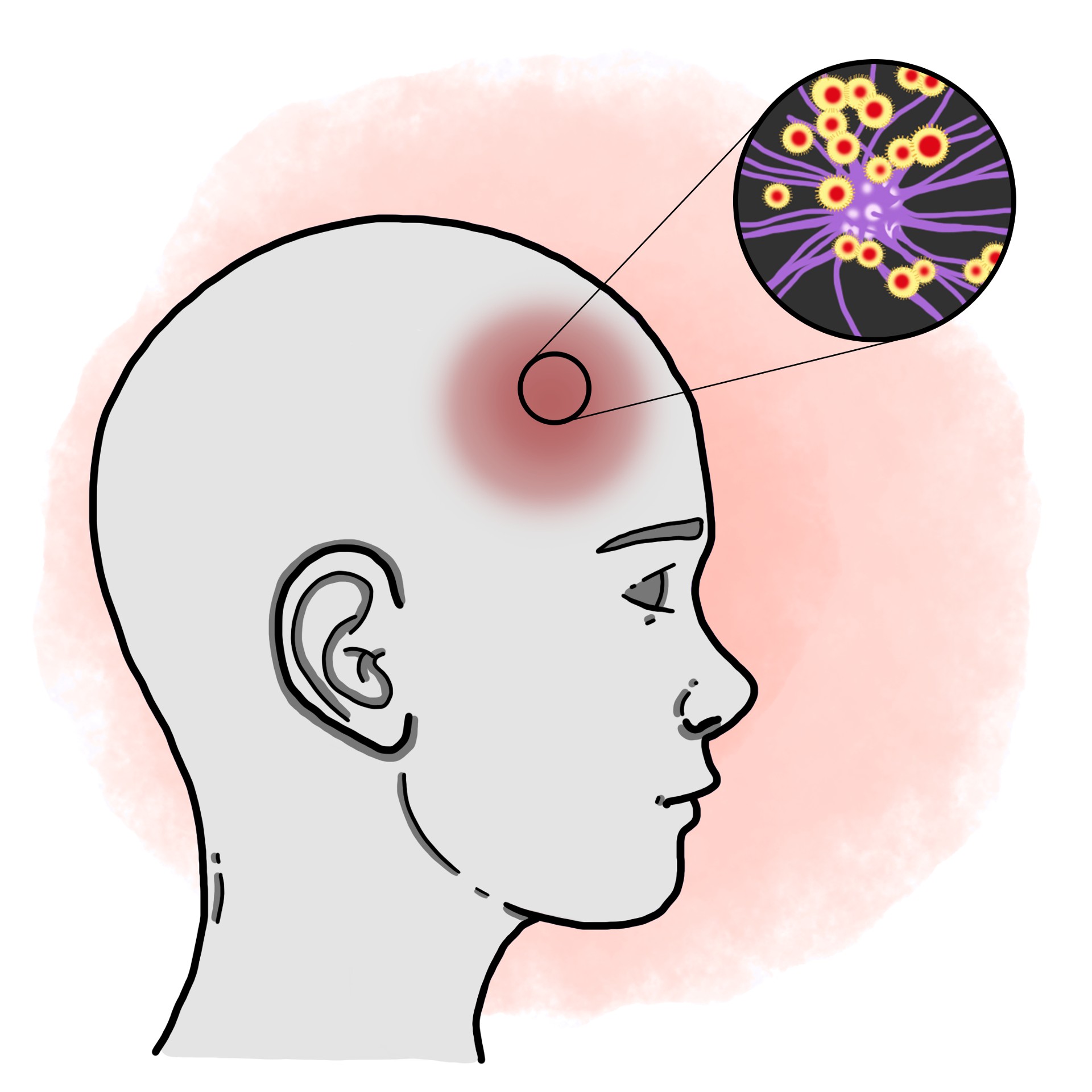 Encephalitis (Paediatrics)