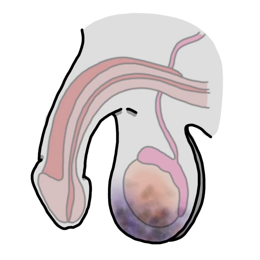 Hematoma escrotal