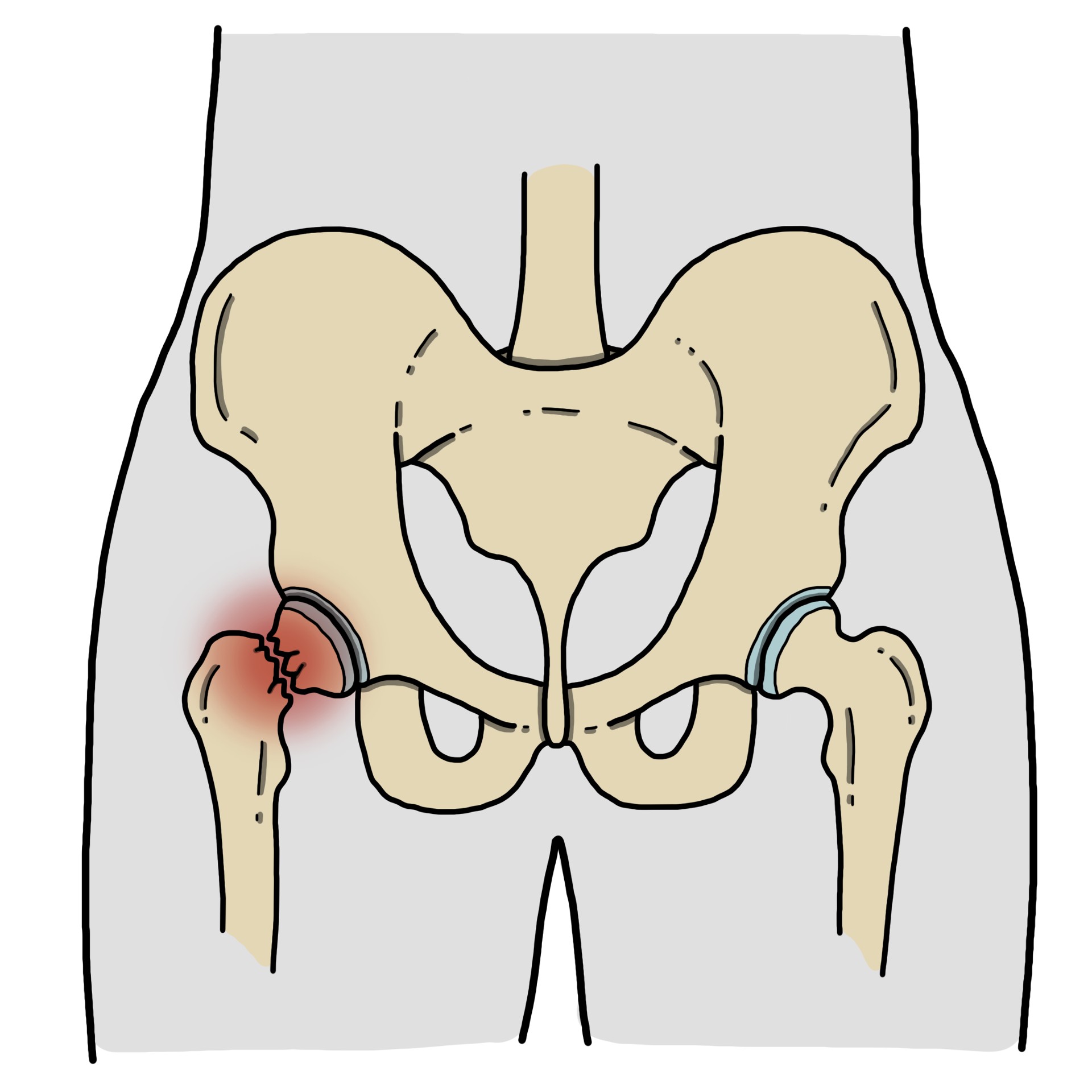 Fracture of the hip
