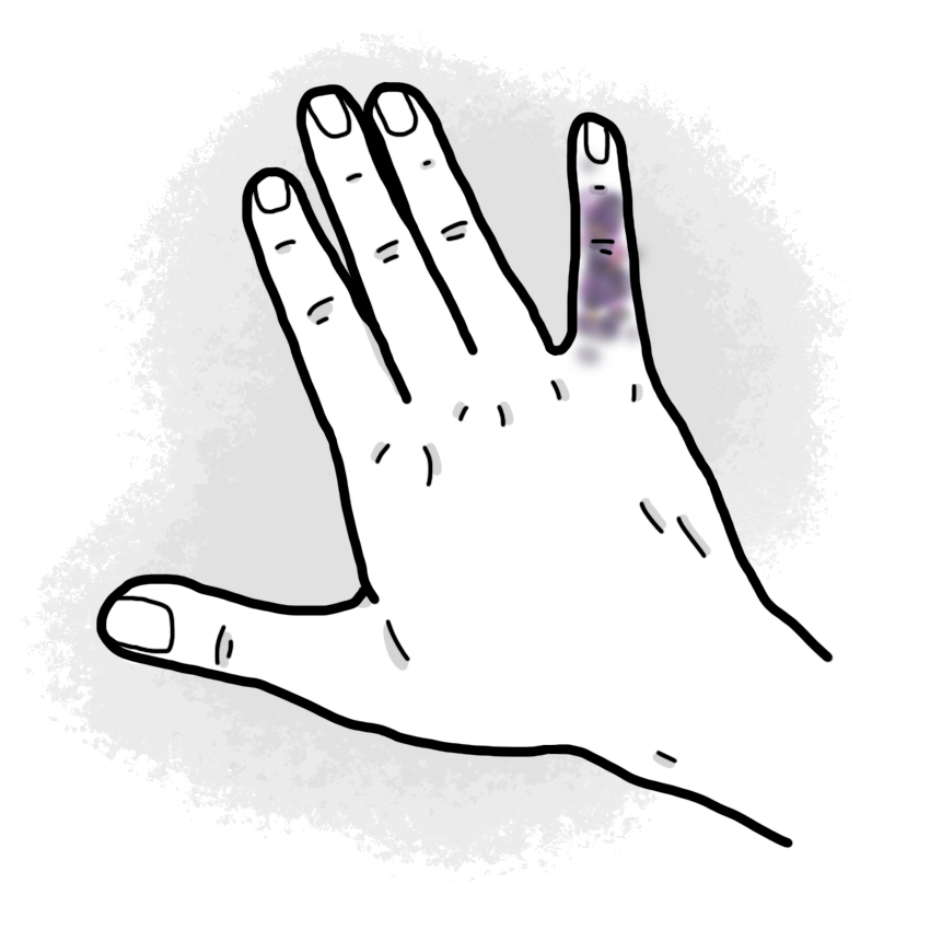 Finger trauma - Finger contusion