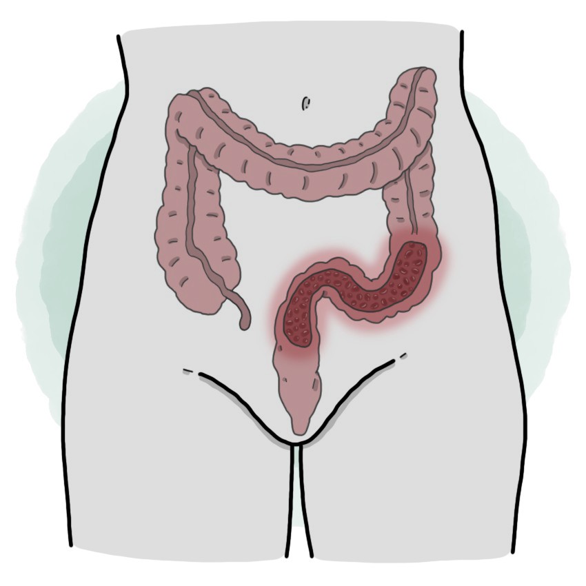 Ulcerative colitis - Inflammatory bowel disease