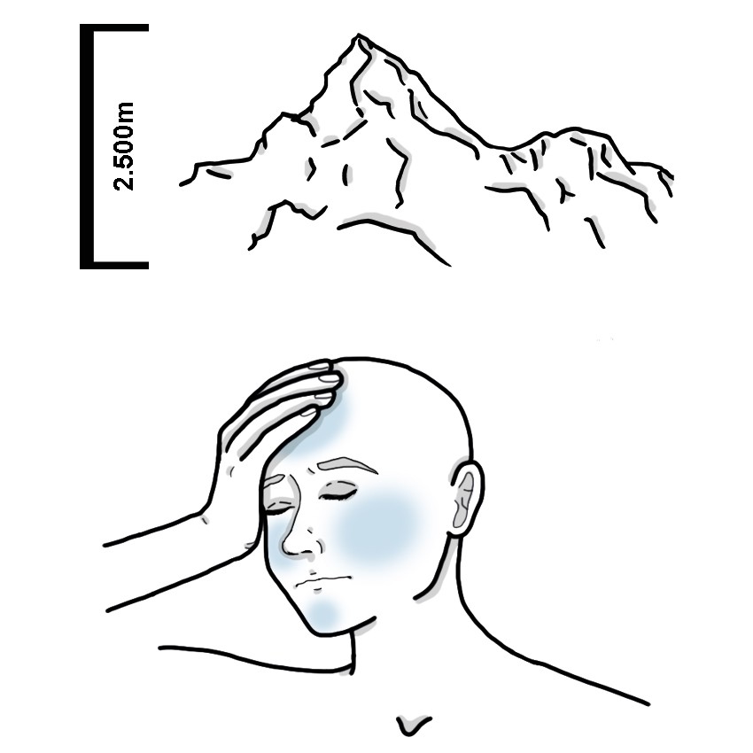 Chronic mountain sickness - Monge's disease