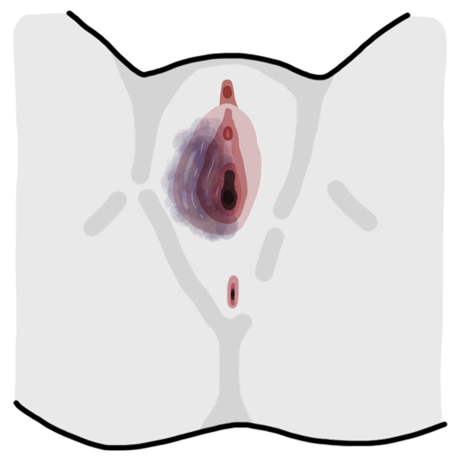Vulvar haematoma
