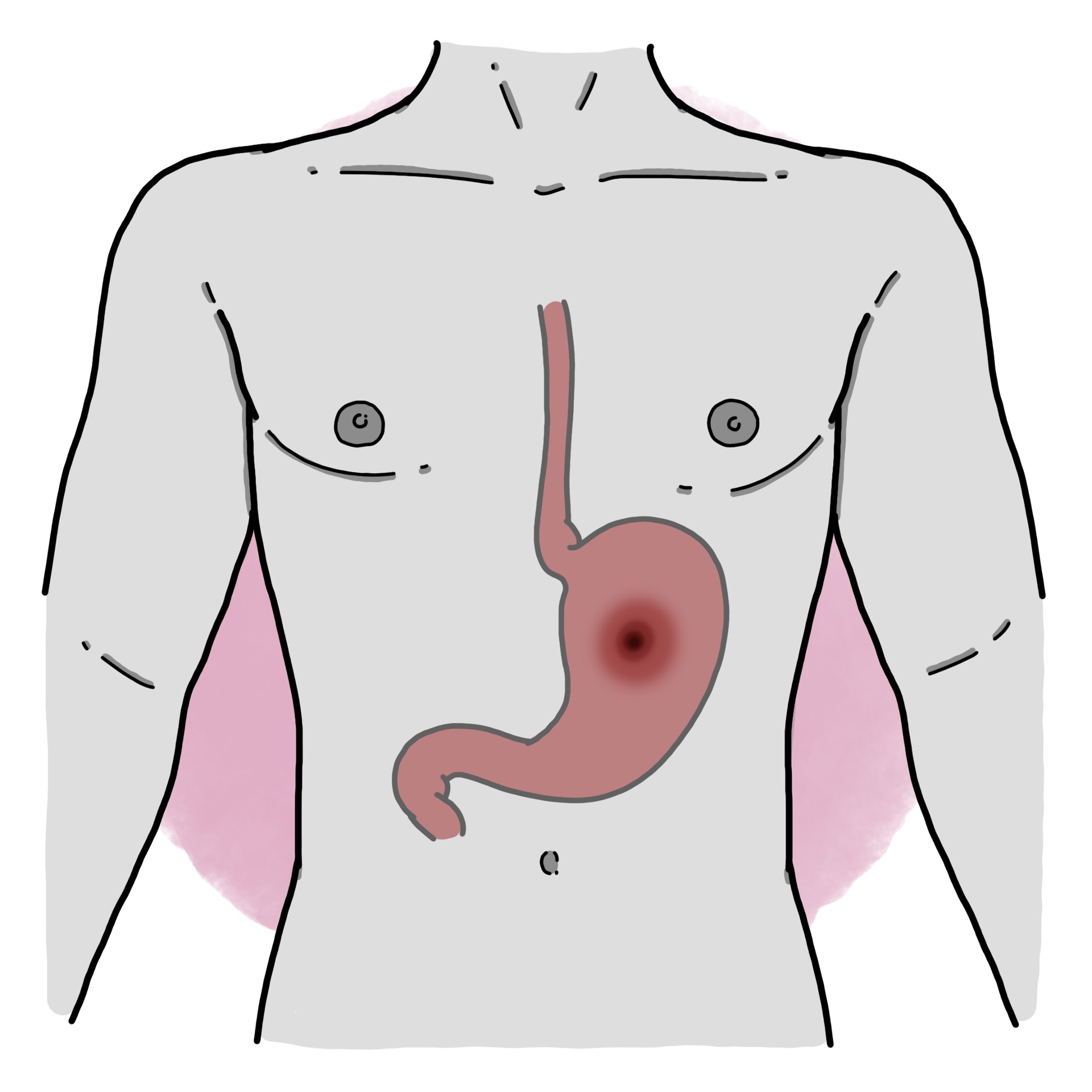 Gastric perforation