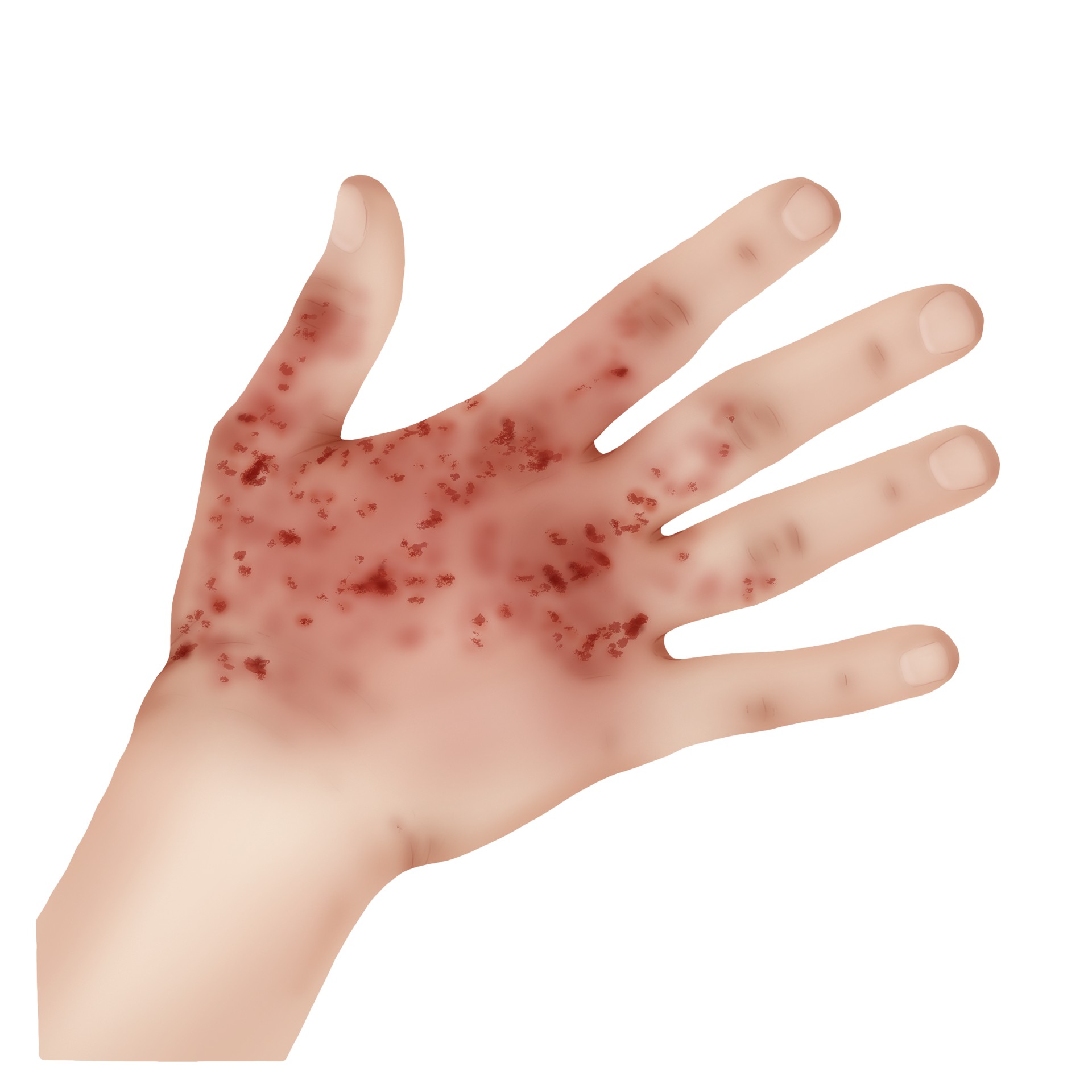 Contact dermatitis