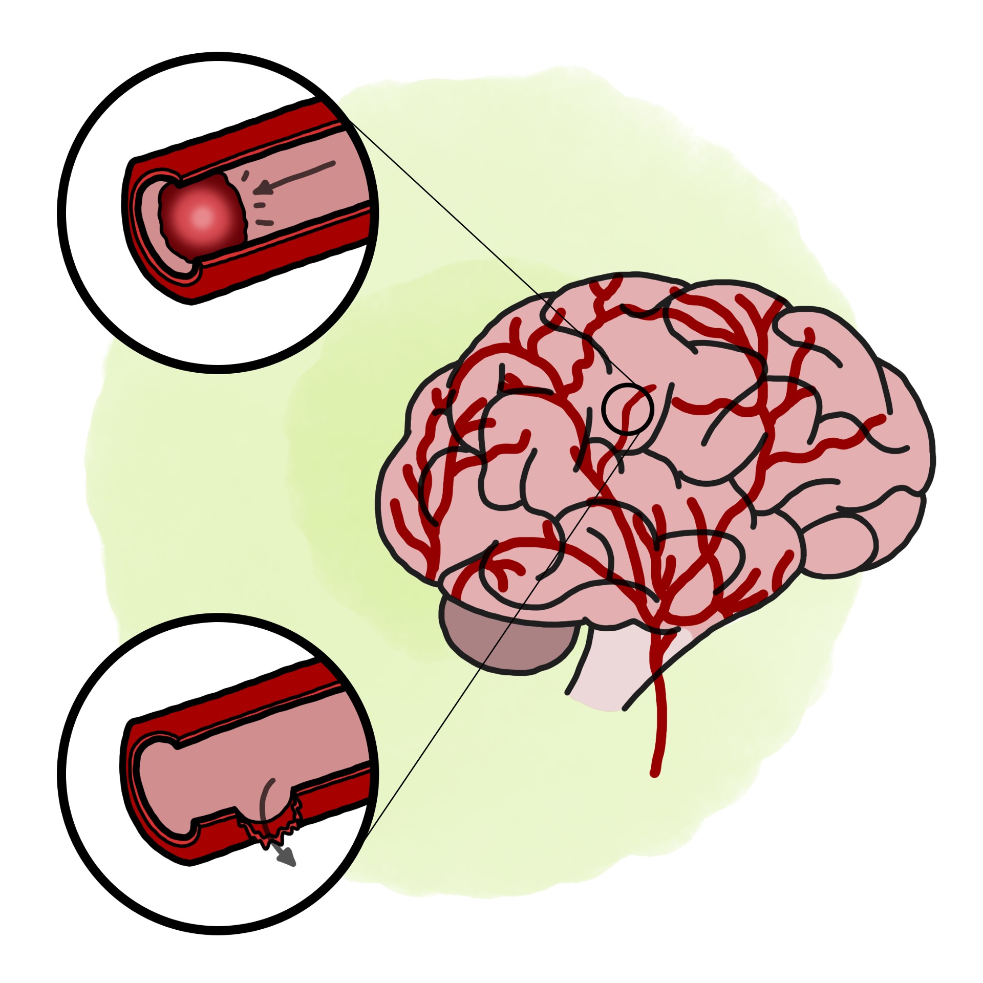 Stroke - Cerebrovascular accident