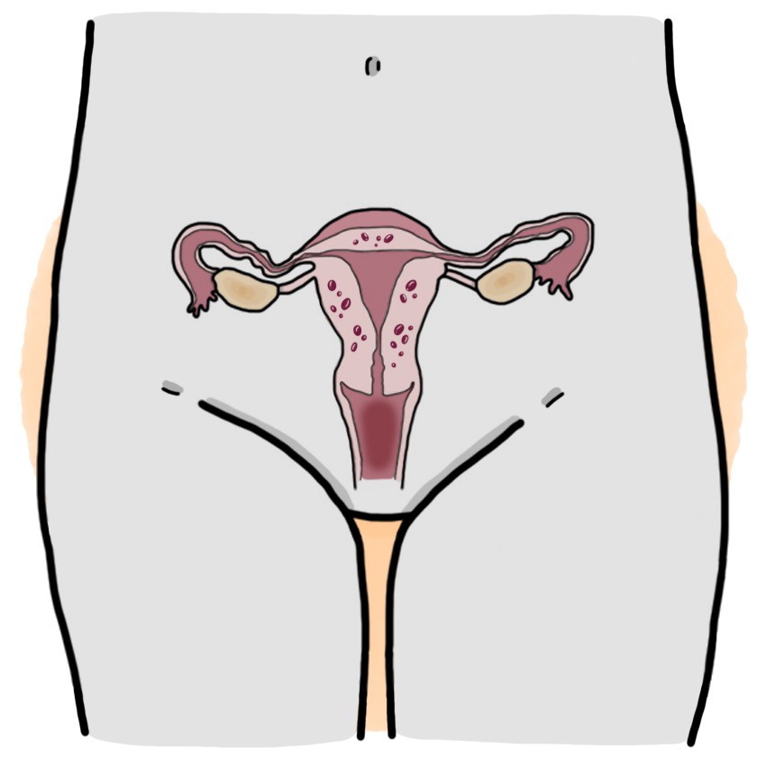 Adenomyosis