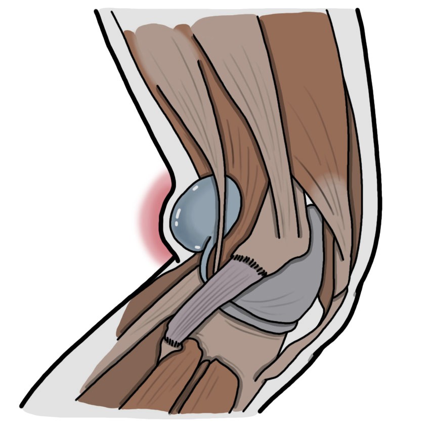 Die Kniekehle ist geschwollen