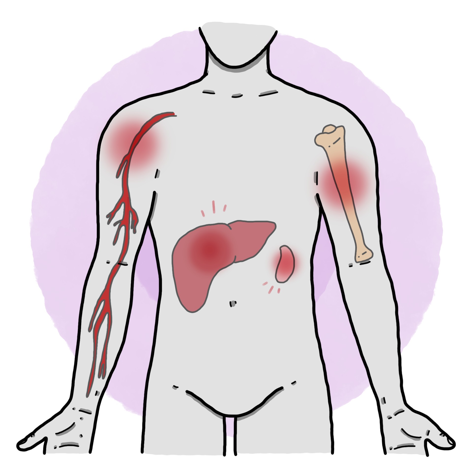 Gaucher's disease type 1