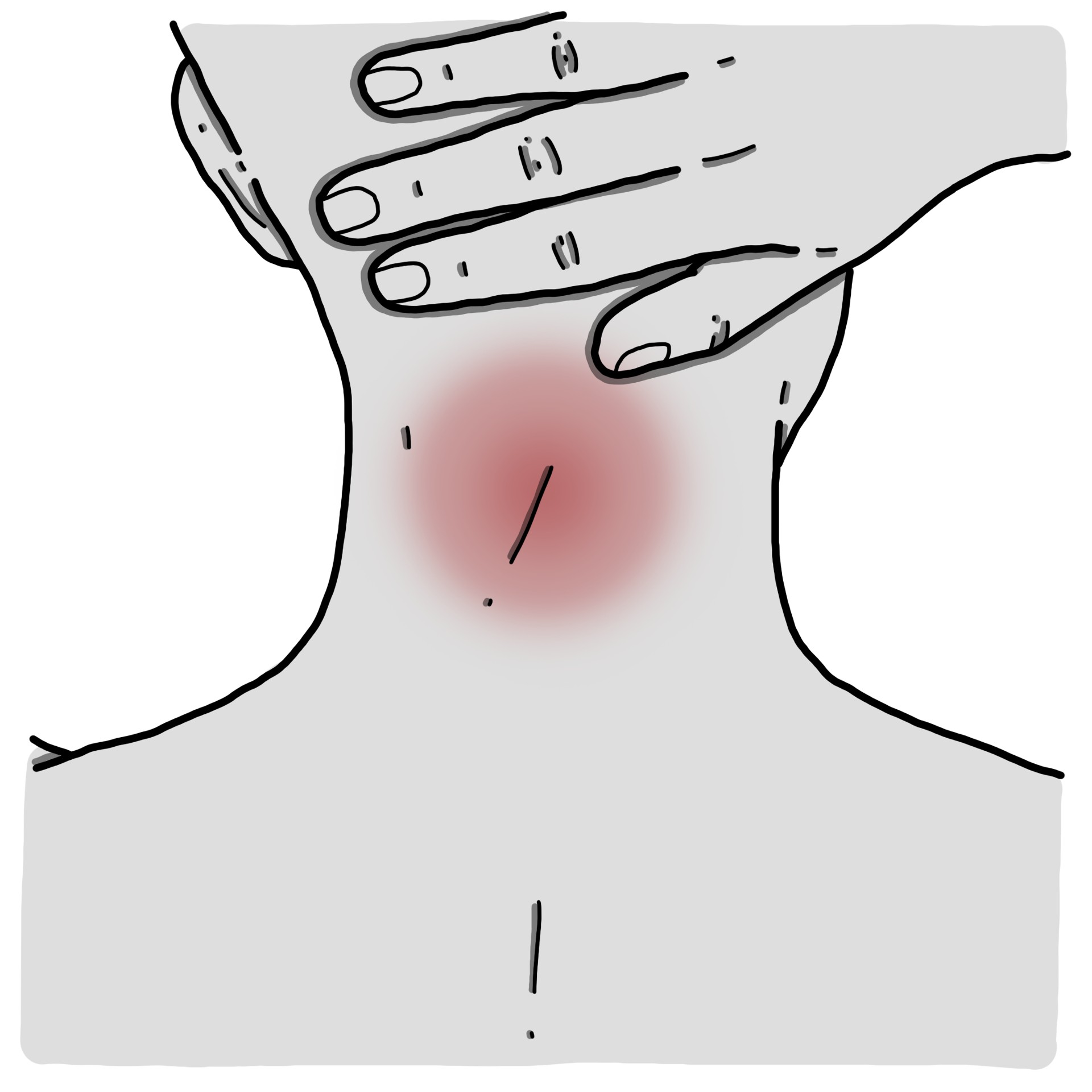 Algia en la zona de inserción de músculos suboccipitales
