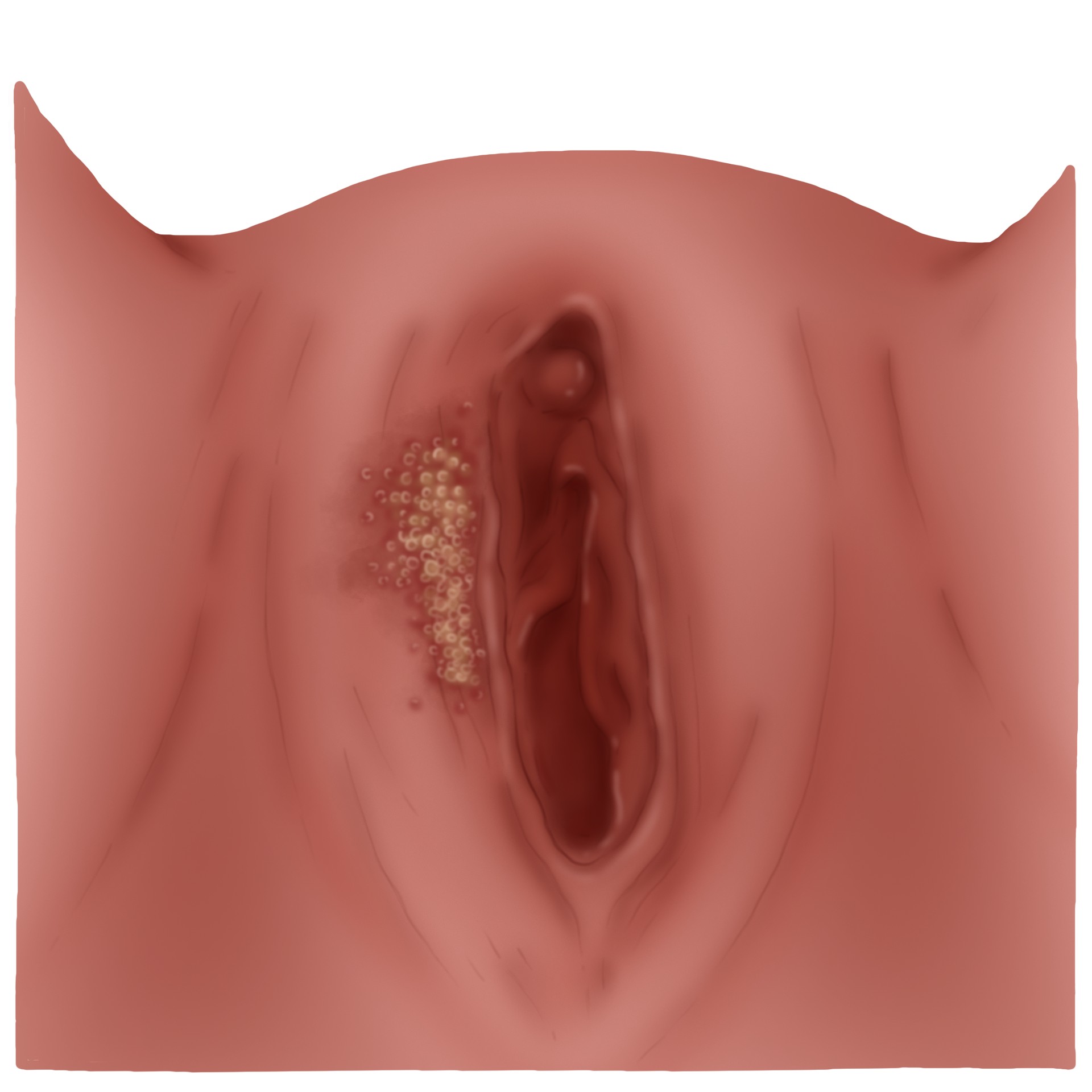 Herpes simplex virus genital infection - HSV